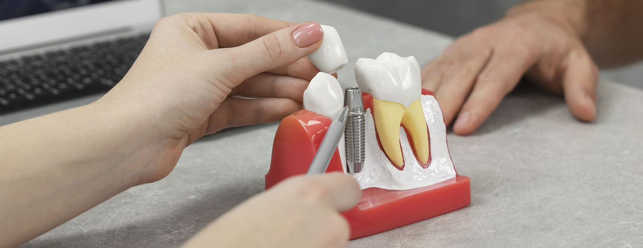 20% Off Dental Implants